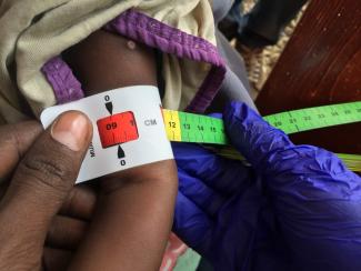 A doctor measures the arm circumference of a severely malnourished baby in Somalia.